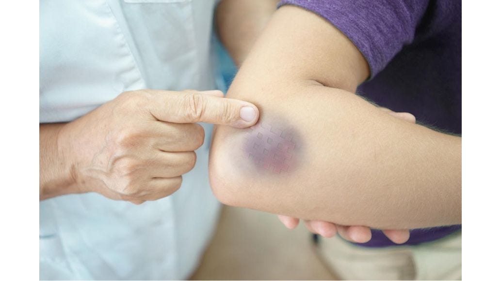 Person pointing to another person's bruise located near their elbow.